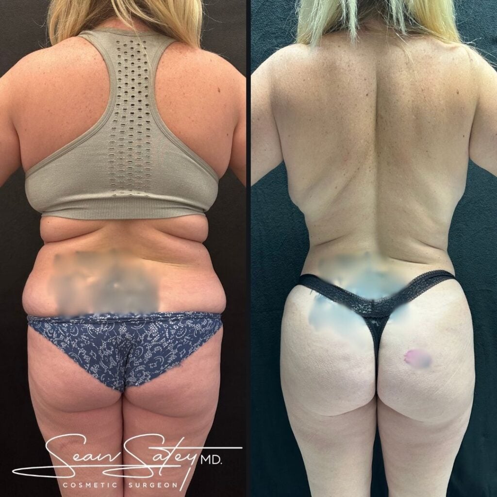 Before after dr satey